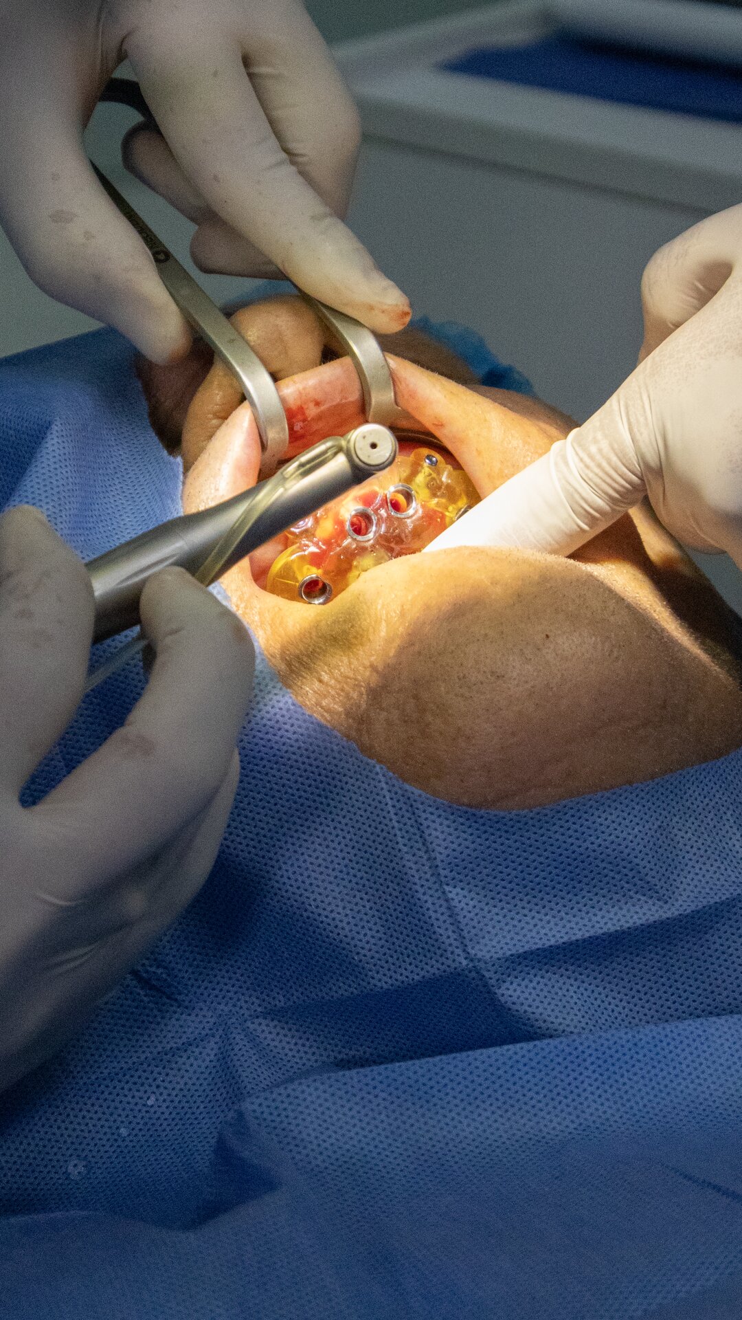 Procedimiento de cirugía oral guiada