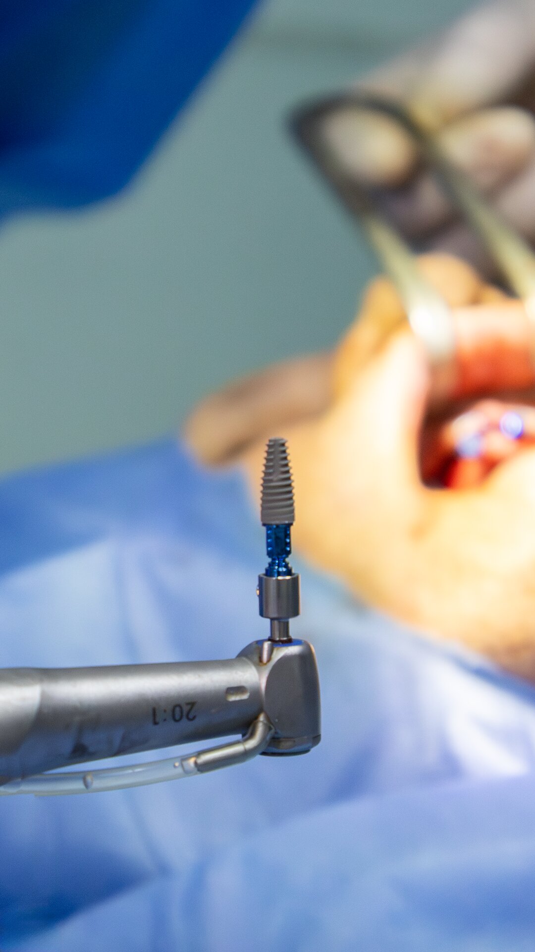 Implante dental de titanio en pieza de mano quirúrgica